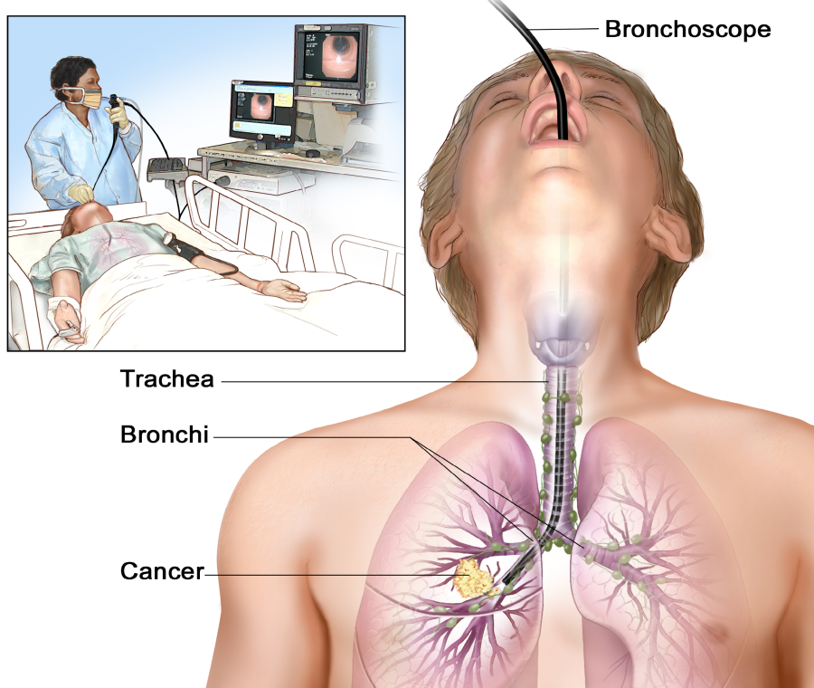 bronchoscopy 1